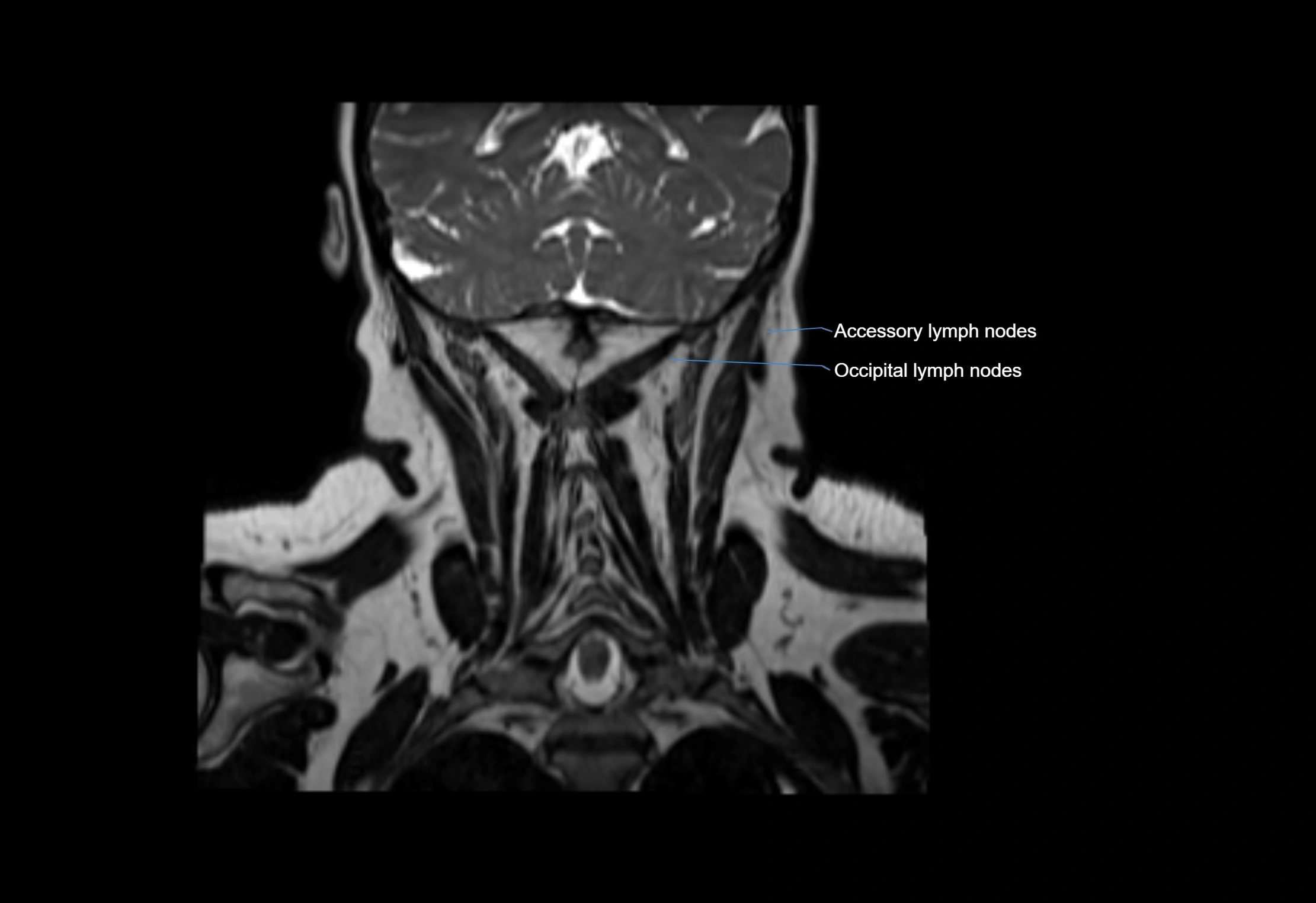 Neck coronal lymph node cross sectional MRI anatomy 3T MRI  image-img-00001-00016.webp